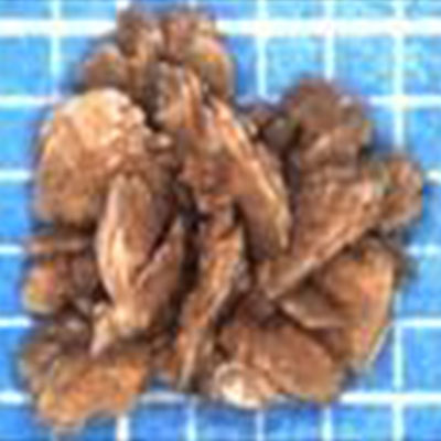 Calcium-Oxalate-Dihydrate-Kidney-Stone-different-type-kidney-crystals