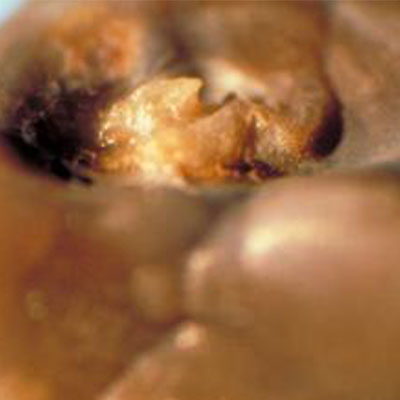 Calcium-Oxalate-Monohydrate-Apatite-Kidney-Stone-different-type-kidney-crystals