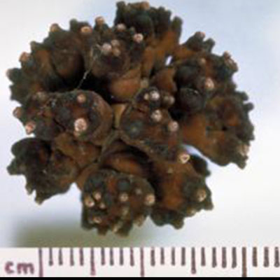 Calcium-Oxalate-Monohydrate-Kidney-Stone-different-type-kidney-crystals