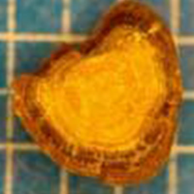 Calcium-Oxalate-Monohydrate-enveloping-Uric-Acid-Kidney-Stone-different-type-kidney-crystals