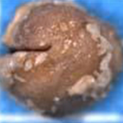 Calcium-Oxalate-Monohydrate-with-superficial-Dihydrate-Kidney-Stone-different-type-kidney-crystals