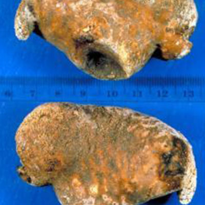 Uric-Acid-Calcium-Oxalate-Monohydrate-Kidney-Stone-different-type-kidney-crystals