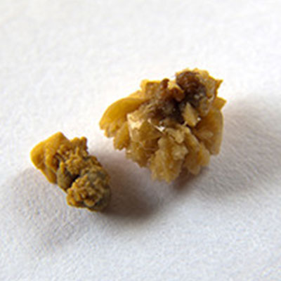 What Are Calcium Oxalate Crystals?